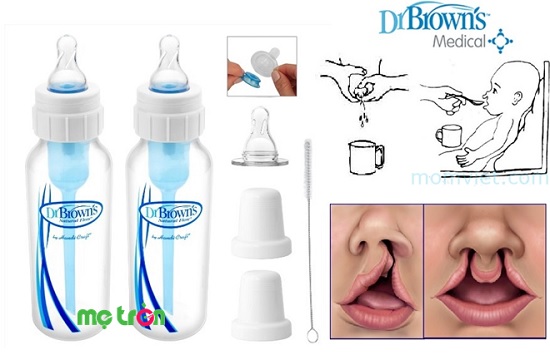 Bình sữa được thiết kế chuyên dùng cho trẻ bị hở hàm ếch, hở vòm họng/sứt môi